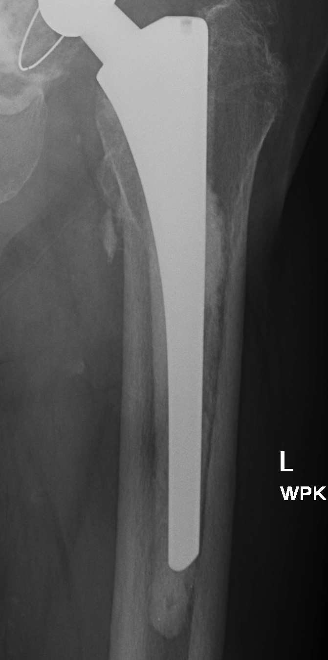 THR Type 3b Cemented Femur